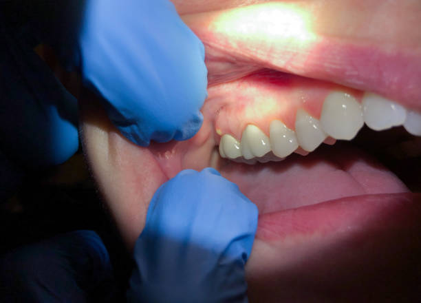 Best Emergency Wisdom Teeth Removal in Madison, FL